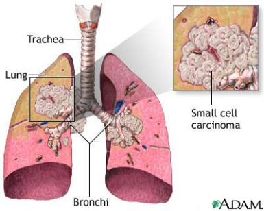 Lung Cancer - Photo - All About Asbestos